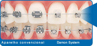 Ortodontia avanada Damon System